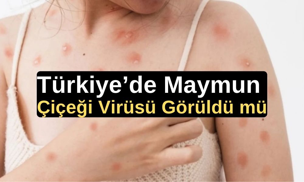 Sağlık Bakanı Kemal Memişoğlu, maymun çiçeği virüsü, Türkiye, alarm durumu, medya temsilcileri, Covid-19 gelişmeleri, Dünya Sağlık Örgütü, YÖK işbirliği, eczanelerde ilaç temini, insan gücü planlaması,